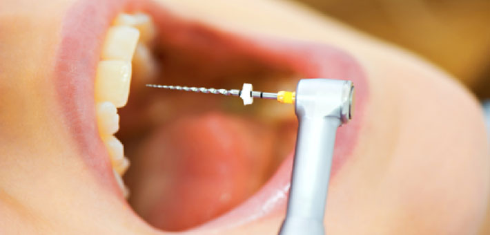 Dental Caries to Root Canal Treatment – Know Before You Go to Dentist