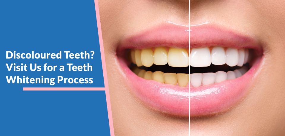 Discoloured Teeth? Visit Us fora Teeth Whitening Process
