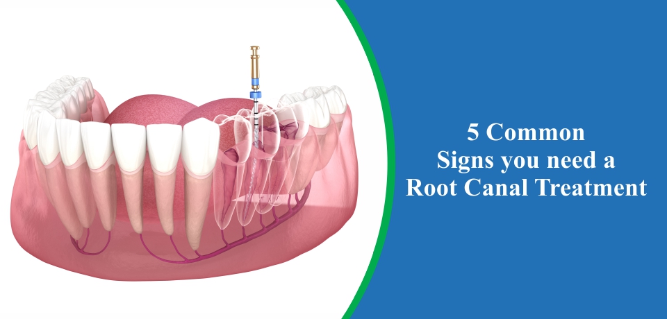 sign of root canal treatment