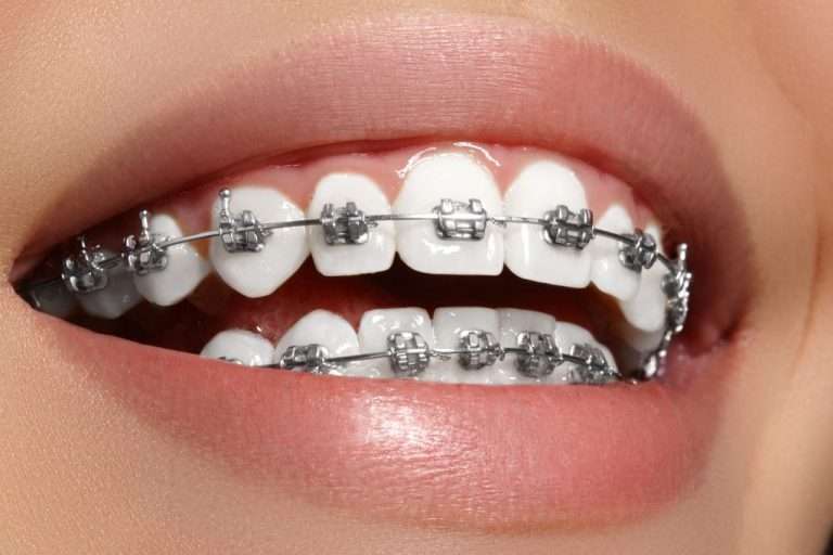 Dental Braces Dubai CrossRoads Dental Clinic In Dubai