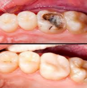 Restored Decayed Tooth Before/After