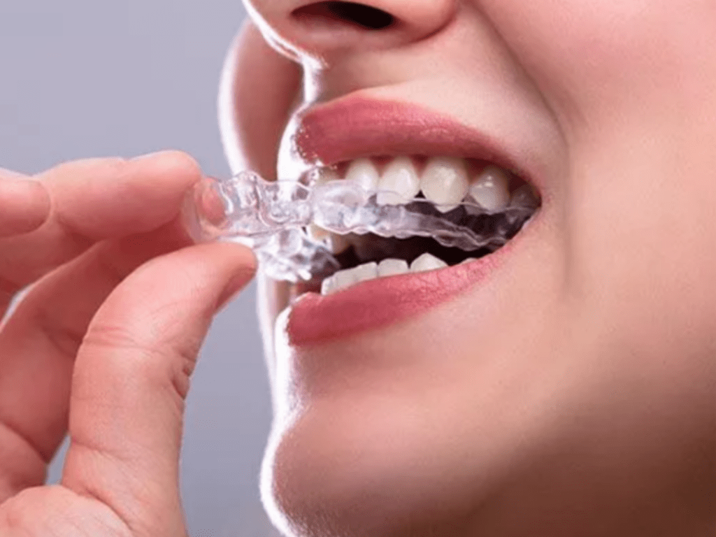 Removable Essix Retainer for teeth alignment at Crossroads Dental Clinic, Sheikh Zayed Road and Deira, Dubai, ensuring clear retainers for straight teeth and smile maintenance.