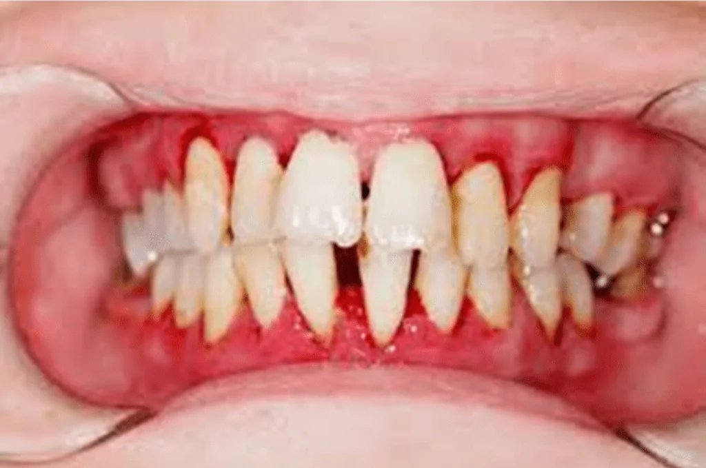 Vitamin C Deficiency & Oral Health