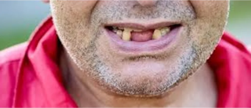 Vitamin C Deficiency & Oral Health