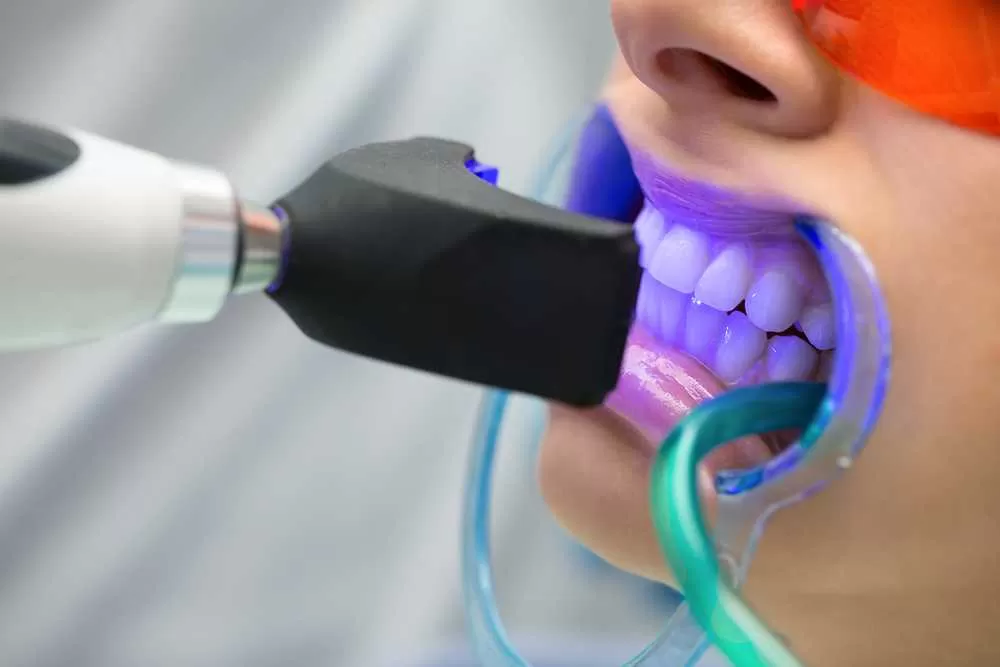 Nano teeth whitening using advanced technology at Crossroads Dental Clinic Sheikh Zayed Road and Deira Dubai for brighter smile