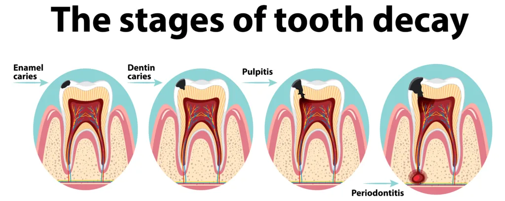 Stages of tooth decay infographic showing early enamel decay, dentin decay, pulp infection, and tooth abscess progression – dental cavity development process explained for oral health and cavity prevention