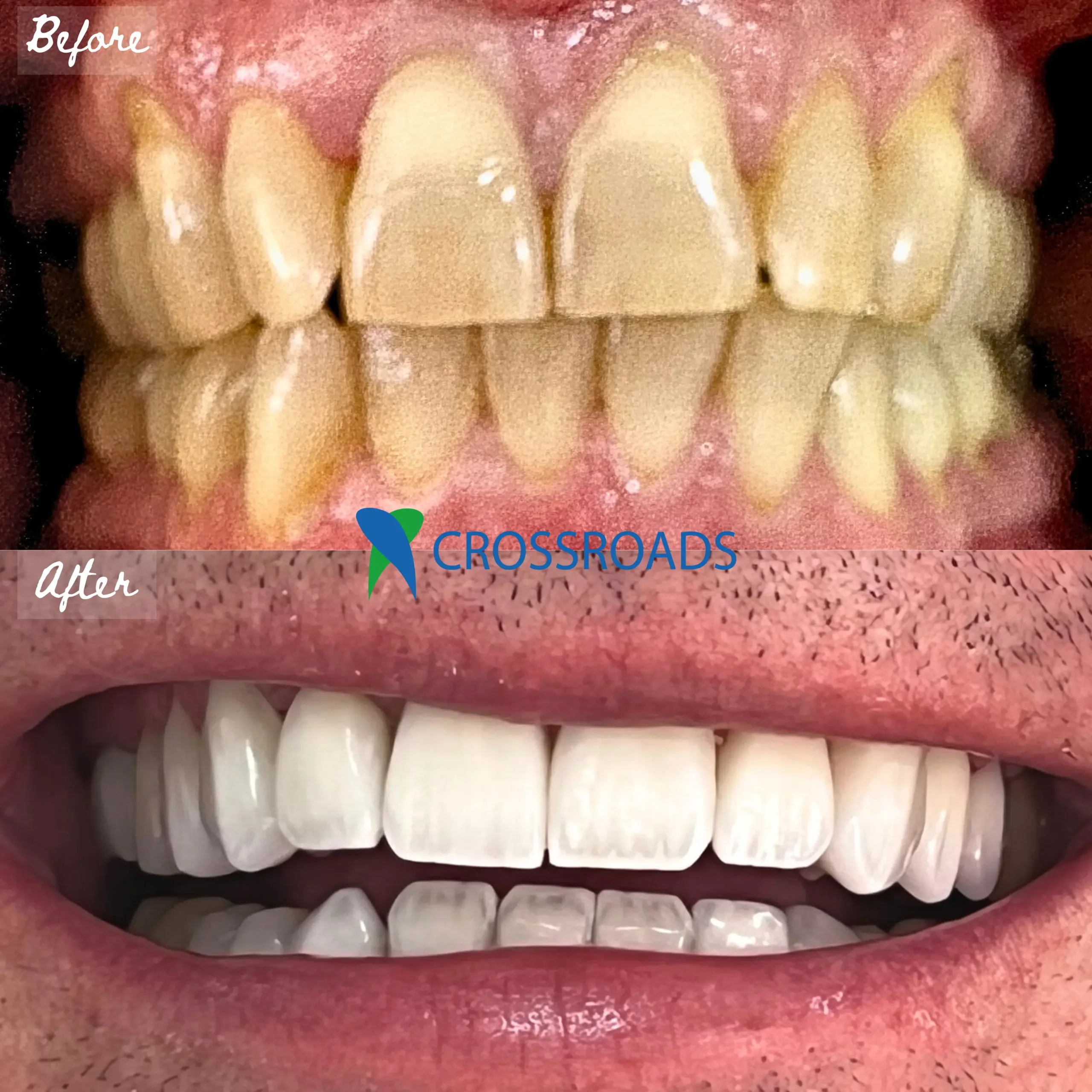 Before and after image of dental veneers and smile makeover at Crossroads Dental Clinic in Dubai, Sheikh Zayed Road and Deira, showing whiter and aligned teeth after cosmetic dentistry treatment.