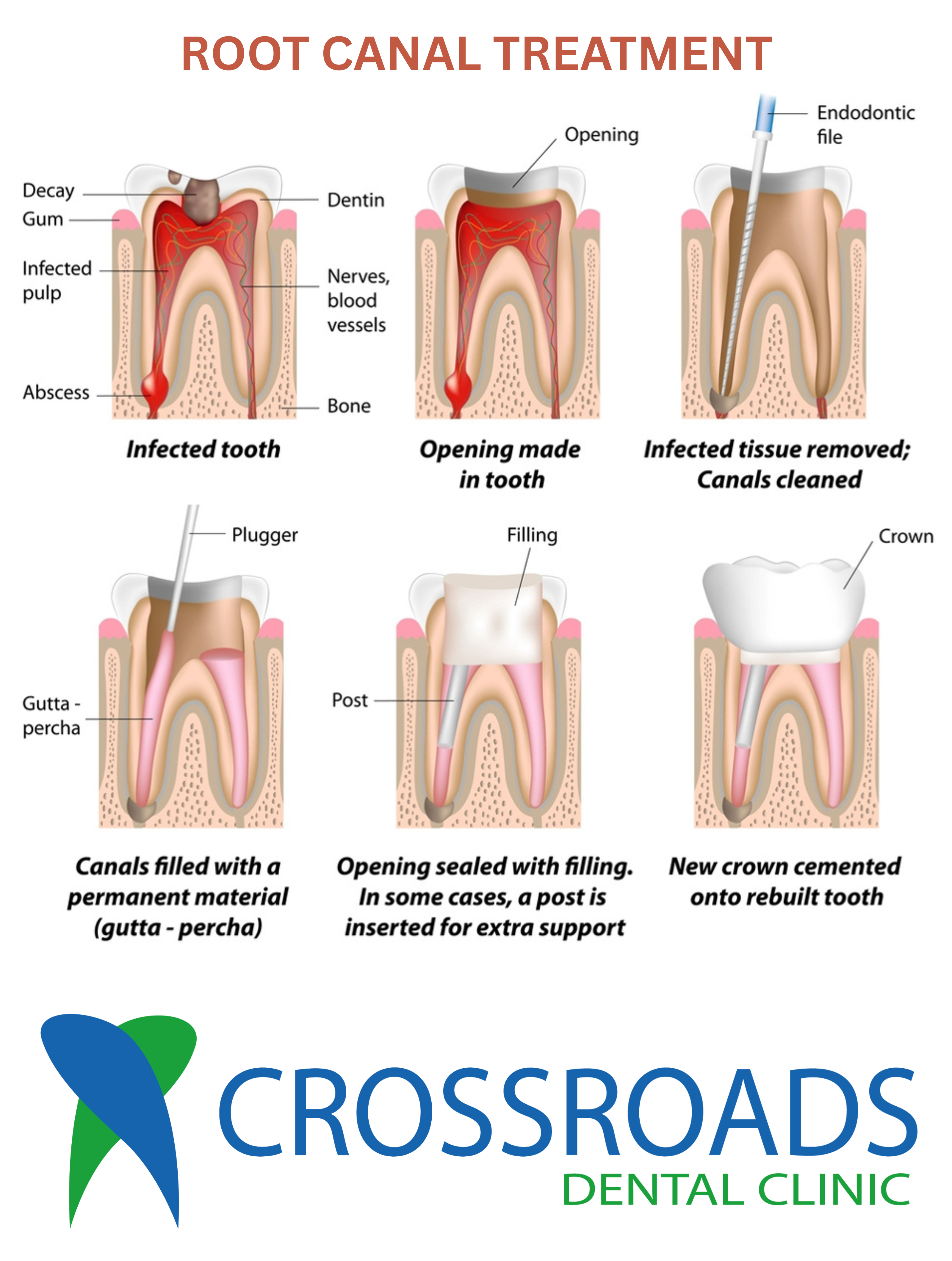 Root canal treatment procedure at Crossroads Dental Clinic Dubai, expert endodontic care in Sheikh Zayed Road and Deira, pain-free root canal therapy for infected teeth, advanced dental treatment in UAE.