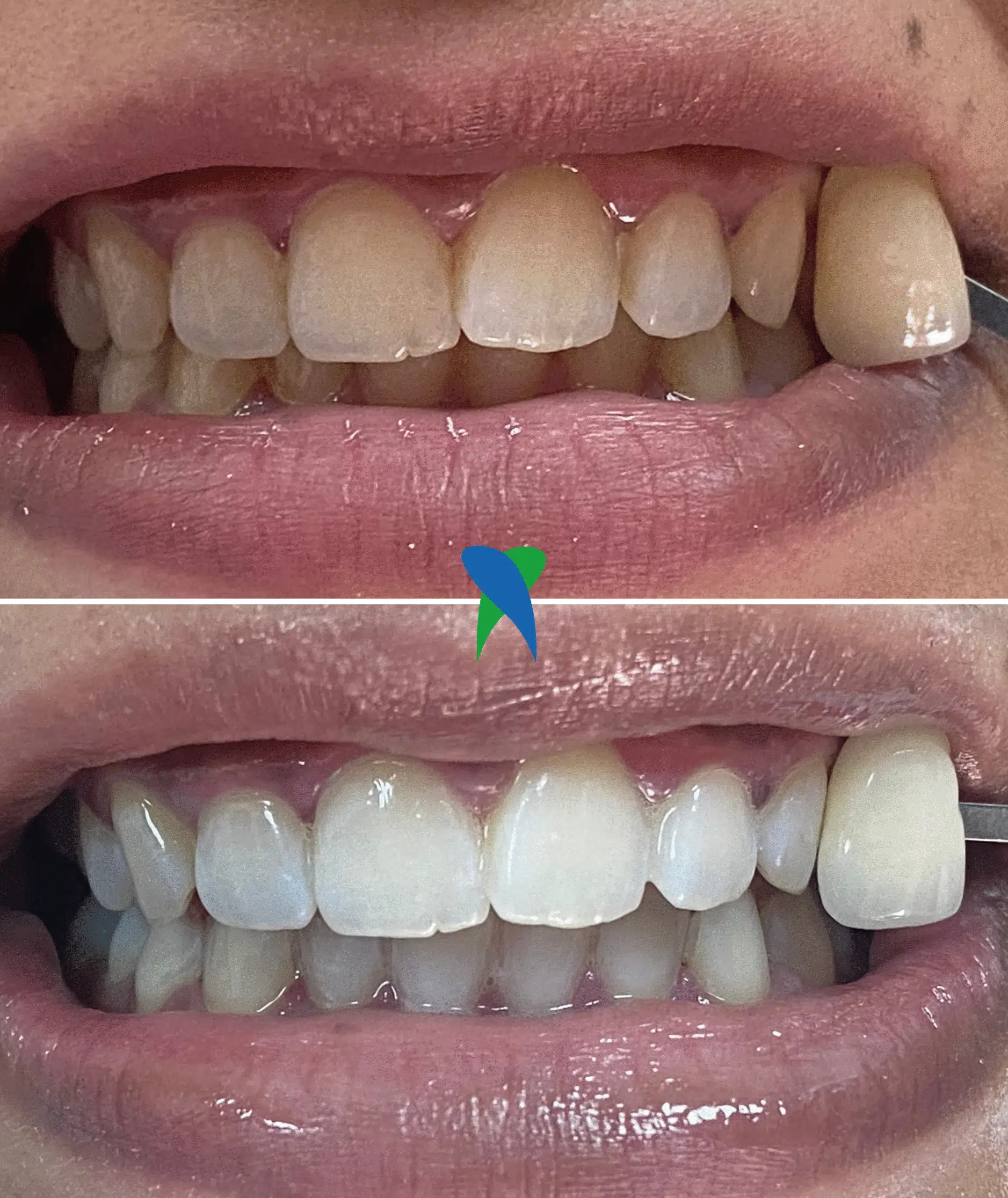 Before and after teeth whitening at Crossroads Dental Clinic Sheikh Zayed Road and Deira Dubai, professional teeth whitening results, brighter smile, Dubai dentist, best teeth whitening Dubai