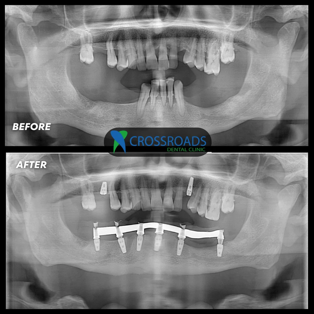 Before and after dental implants X-rays for multiple missing teeth treatment at Crossroads Dental Clinic, Sheikh Zayed Road and Deira, Dubai
