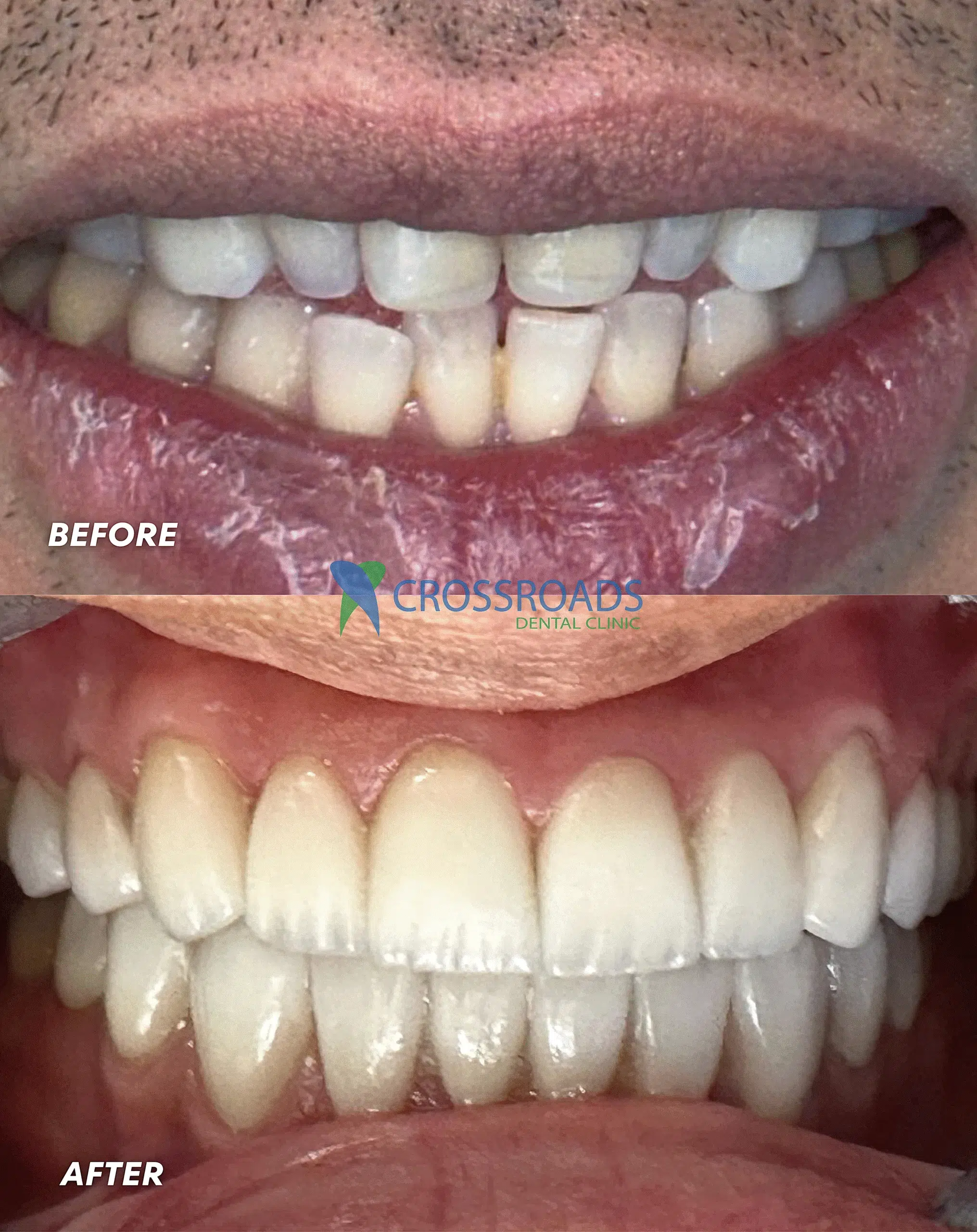 Before and after image of dental veneers and smile makeover at Crossroads Dental Clinic in Dubai, Sheikh Zayed Road and Deira, showing whiter and aligned teeth after cosmetic dentistry treatment.