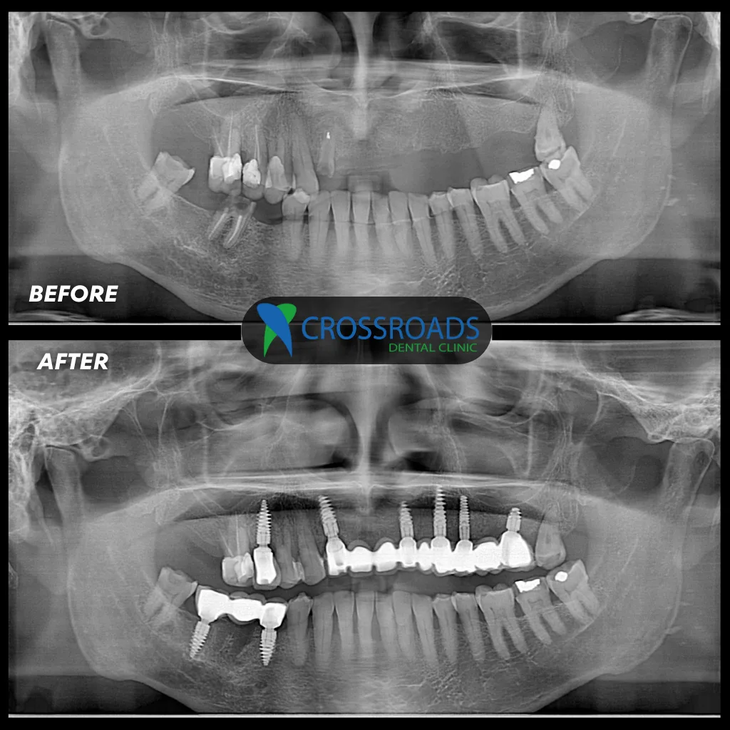 Before and after dental implants X-rays for multiple missing teeth treatment at Crossroads Dental Clinic, Sheikh Zayed Road and Deira, Dubai