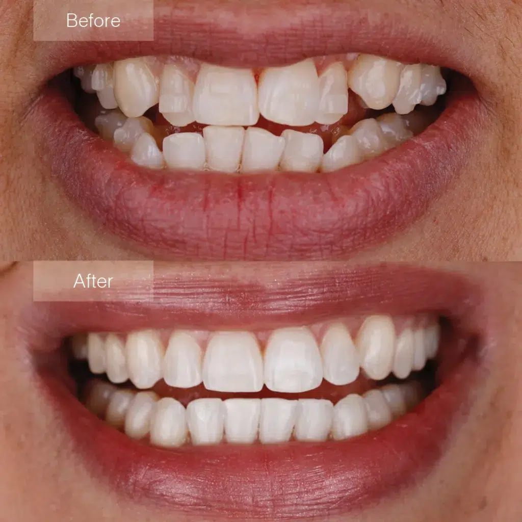 Before and After Invisalign treatment results at Crossroads Dental Clinic Dubai, showcasing teeth straightening and smile transformation at Sheikh Zayed Road and Deira locations.