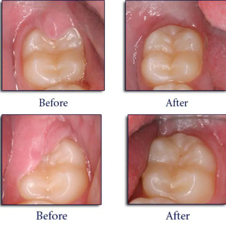 Before and After Operculectomy treatment for pericoronitis at Crossroads Dental Clinic, Sheikh Zayed Road and Deira Dubai – expert dental care for inflamed gum removal and wisdom tooth relief.