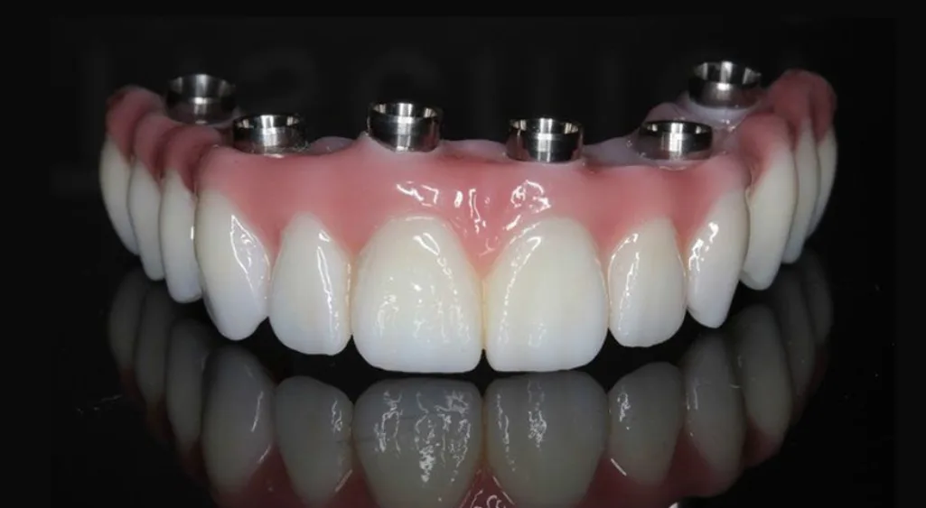 FULL MOUTH REHABILITATION at Crossroads Dental Clinic, Sheikh Zayed Road and Deira, Dubai