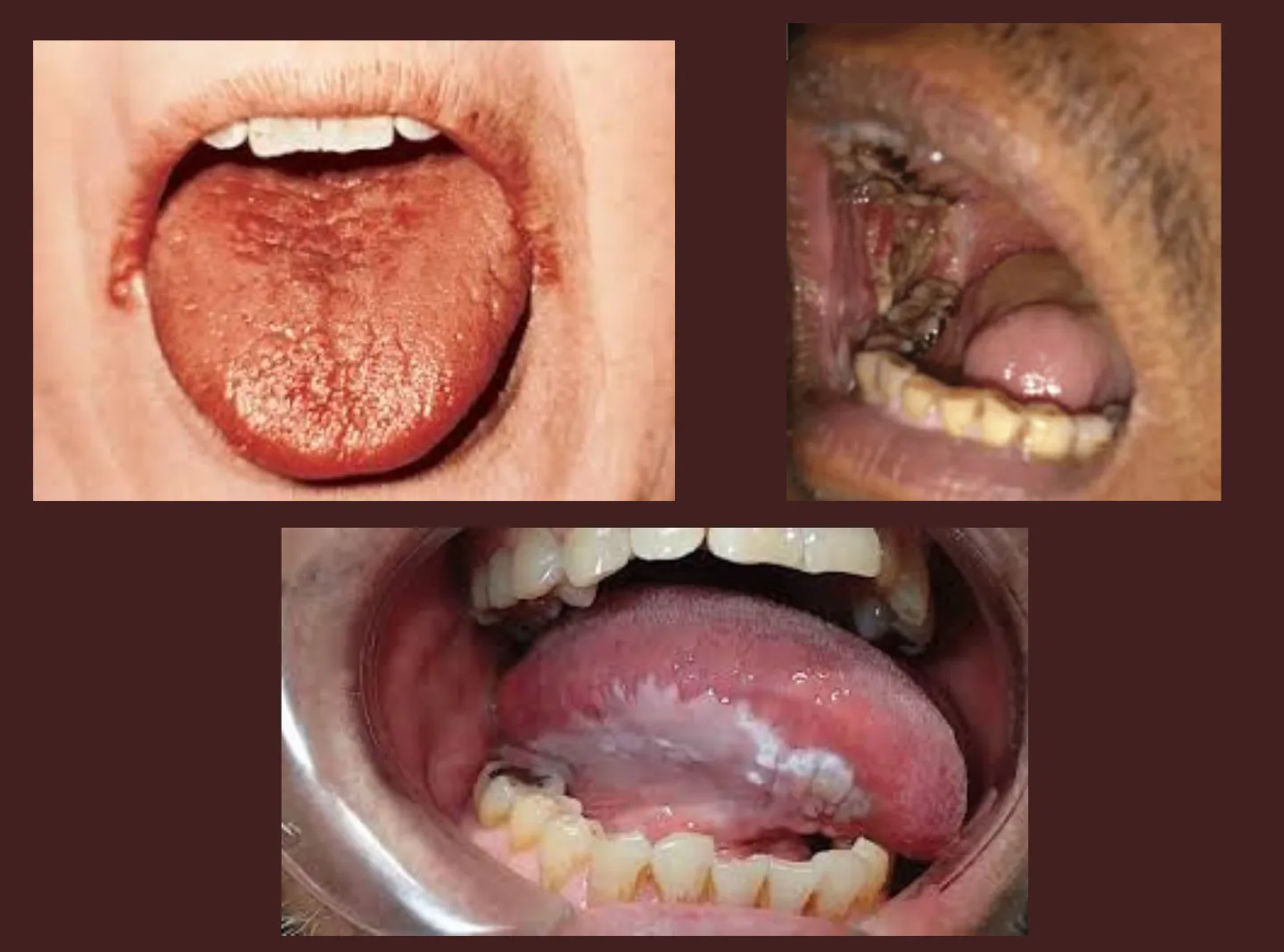 does chewing tobacco cause cavities Harmful Effects of Tobacco Chewing on Oral Health