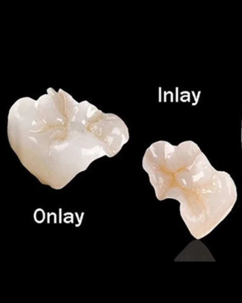 Onlays and inlays treatment at Crossroads Dental Clinic Dubai, affordable tooth restoration in Sheikh Zayed Road and Deira, cosmetic and restorative dentistry
