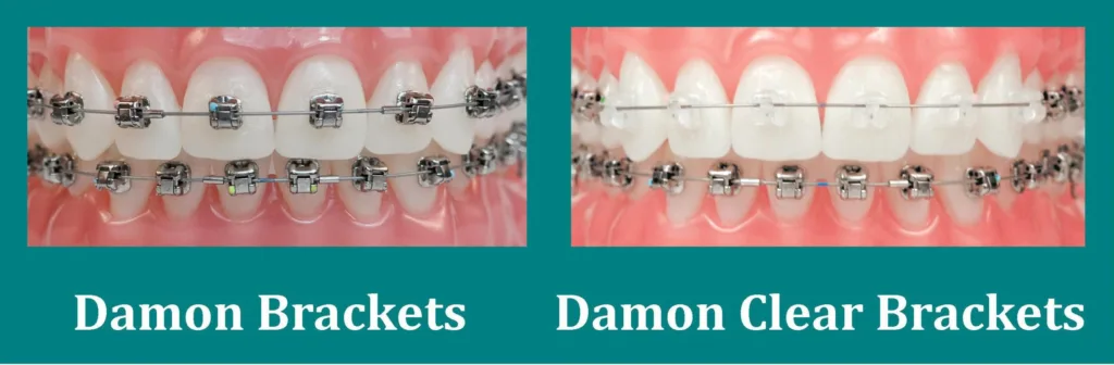 Damon Braces at Crossroads Dental Clinic Dubai, advanced orthodontics in Sheikh Zayed Road and Deira for straight teeth without extractions.