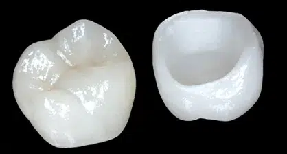 E-Max Crowns (Lithium Disilicate) for natural-looking dental restorations at Crossroads Dental Clinic in Sheikh Zayed Road and Deira Dubai