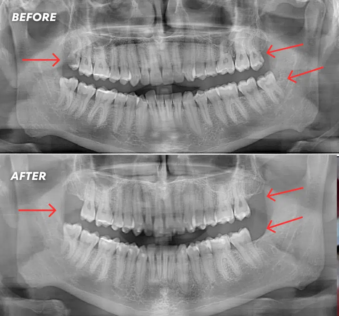 Before and after X-ray of wisdom tooth extraction at Crossroads Dental Clinic in Dubai, showing impacted wisdom tooth removal results at our Sheikh Zayed Road and Deira branches