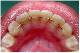 Fixed Lingual Retainer at Crossroads Dental Clinic Dubai, Deira and Sheikh Zayed Road, for teeth alignment and orthodontic retention