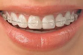 Ceramic braces treatment at Crossroads Dental Clinic in Dubai, affordable orthodontics at Sheikh Zayed Road and Deira for straight teeth