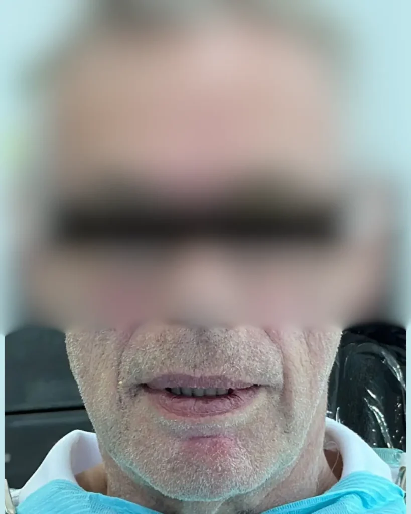 Before full mouth rehabilitation at Crossroads Dental Clinic Dubai showing improved oral health, bite alignment, and smile transformation in Sheikh Zayed Road and Deira.
