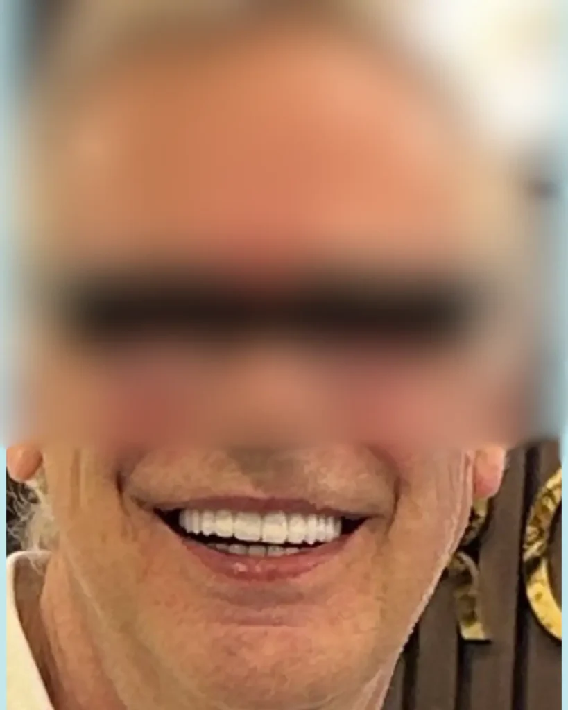 After full mouth rehabilitation at Crossroads Dental Clinic Dubai showing improved oral health, bite alignment, and smile transformation in Sheikh Zayed Road and Deira.