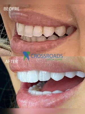 Before and after image of dental veneers and smile makeover at Crossroads Dental Clinic in Dubai, Sheikh Zayed Road and Deira, showing whiter and aligned teeth after cosmetic dentistry treatment.