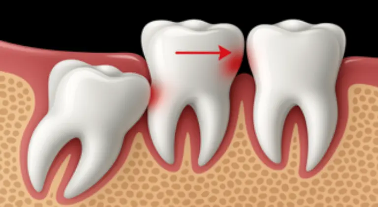 Wisdom tooth extraction in Dubai at Crossroads Dental Clinic, Sheikh Zayed Road and Deira, safe teeth extraction services by experienced Dubai dentists for pain-free removal.
