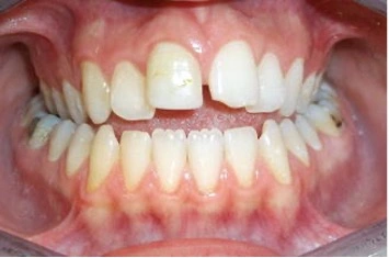 Effects of chronic mouth breathing on teeth alignment, jaw development, and facial structure in children and adults.