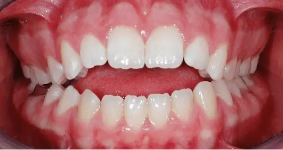 Prolonged bottle feeding in babies causing tooth decay and dental alignment issues