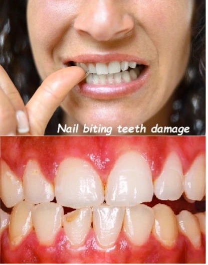 Close-up of teeth damaged by chronic nail-biting habit, showing chipped enamel and dental wear
