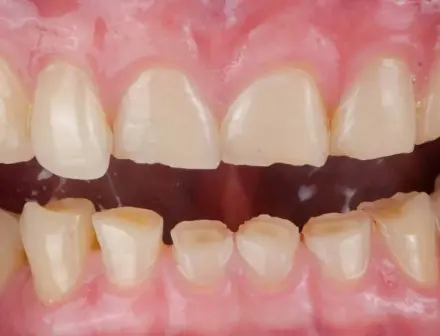 Person suffering from teeth grinding (bruxism) with jaw pain and worn teeth – common signs of nighttime teeth clenching and grinding disorder.
