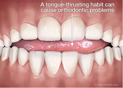 Child with tongue thrusting habit affecting teeth alignment and causing bite issues — early orthodontic concern.