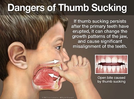 Child thumb sucking leading to dental issues like misaligned teeth, overbite, and jaw development problems – pediatric oral health warning