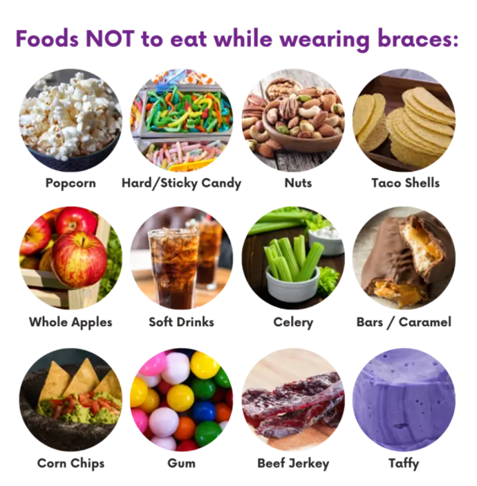 Common foods to avoid with braces such as popcorn, candy, nuts, and caramel.