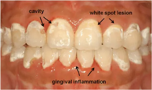 White spot lesions on teeth with braces, showing enamel damage, cavity formation, and gingival inflammation.