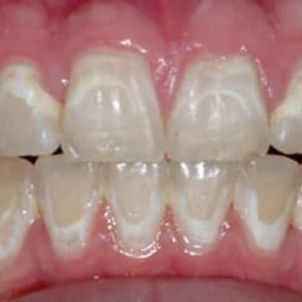 White spot lesions visible on teeth after braces removal, showing uneven enamel coloration.