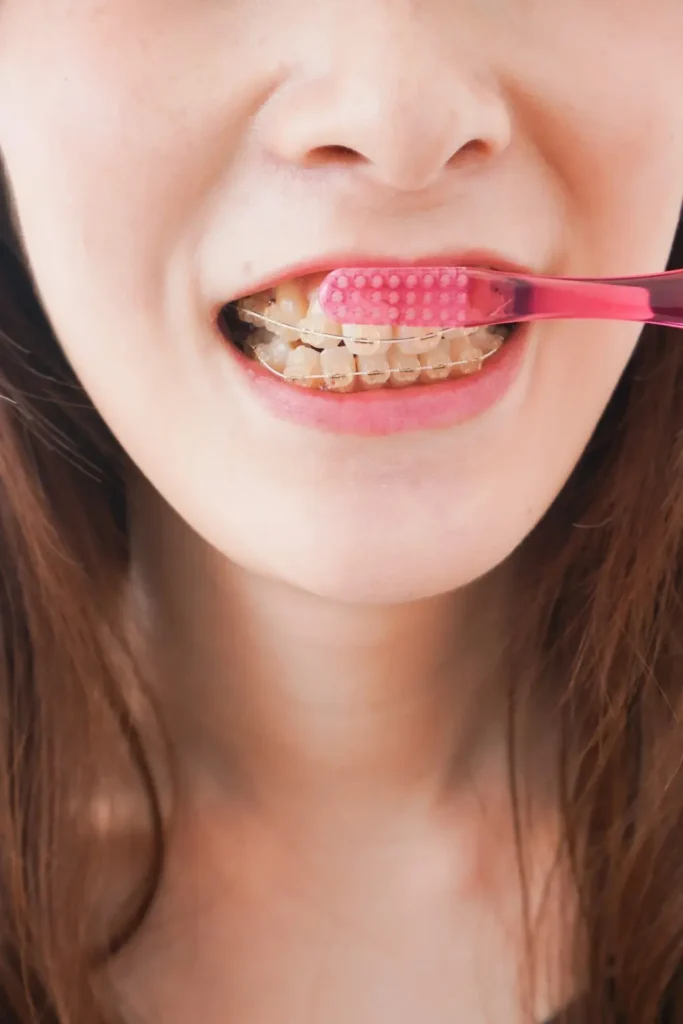 Correct brushing technique around braces to prevent white spot lesions and enamel damage