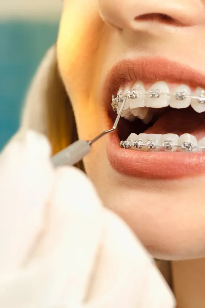 Dental cleaning appointment during orthodontic treatment to prevent white spot lesions