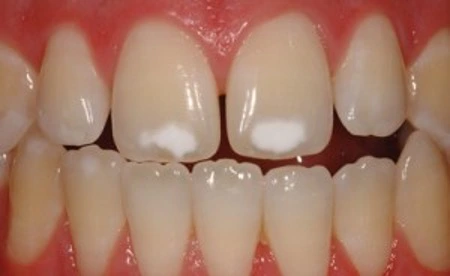 White spot lesions on front teeth caused by enamel demineralization often seen after braces or orthodontic treatment