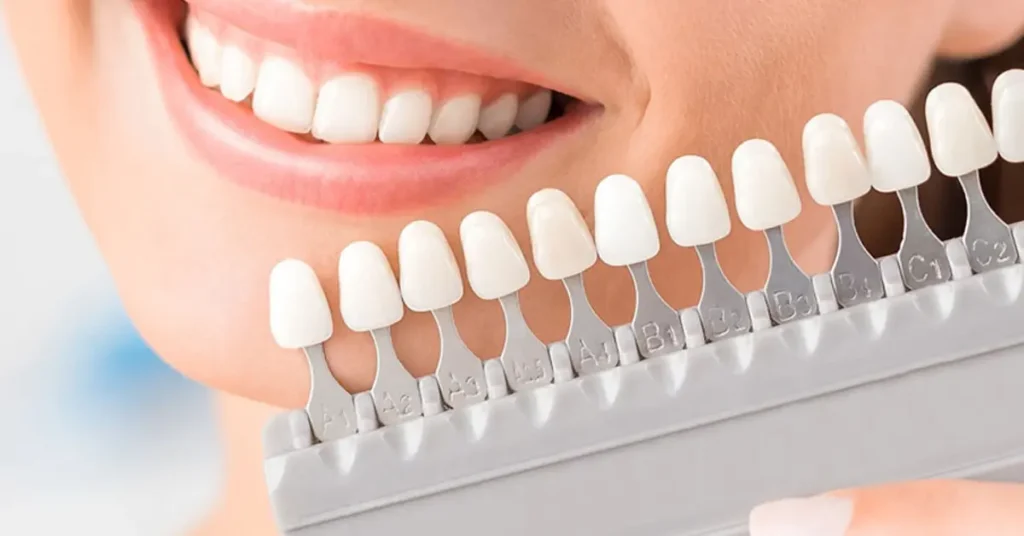 Dentist placing porcelain veneer on front tooth