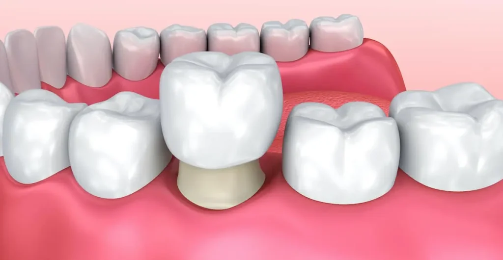 Dental crown covering entire molar tooth
