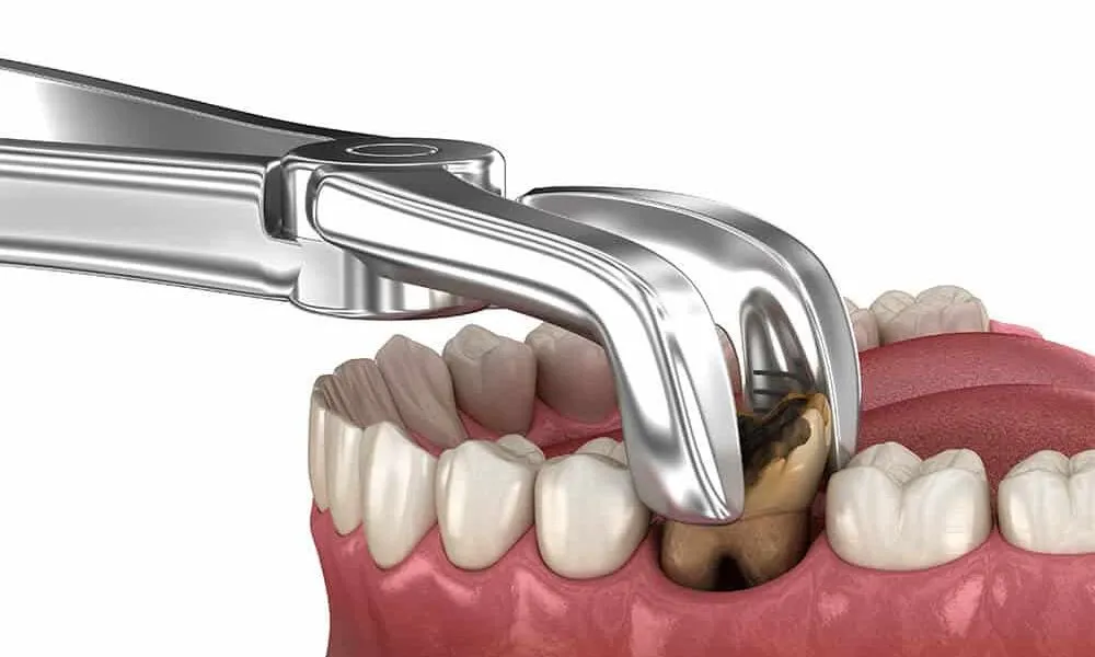 Dentist performing simple tooth extraction procedure