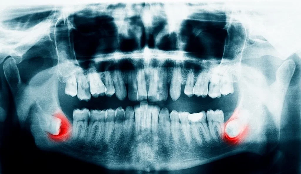 Surgical tooth extraction with gum incision and stitches