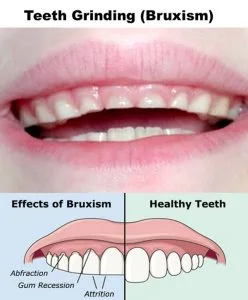 Illustration of teeth grinding at night showing jaw clenching