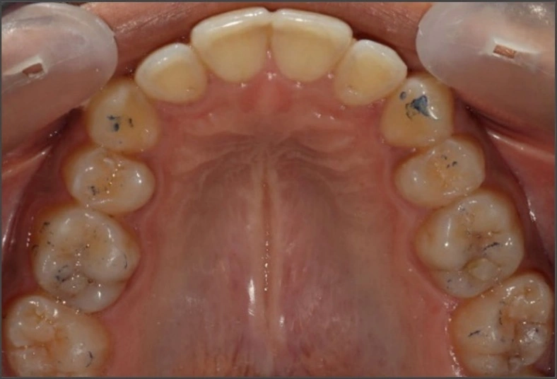 Person experiencing jaw pain due to nighttime teeth grinding