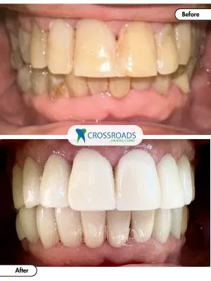 Before and after veneers treatment improving tooth color and shape and oral health in Crossroads Dental Clinic Dubai