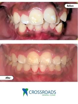 Before and after orthodontic treatment fixing gaps and bite issues with braces in Crossroads Dental Clinic Dubai